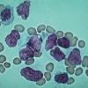 LM of blood smear in acute lymphocytic leukaemia- credit - science photo library - m1320005