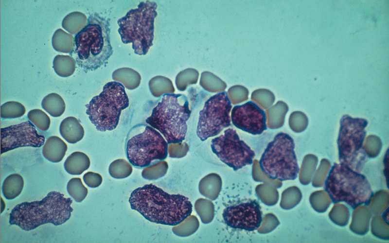 LM of blood smear in acute lymphocytic leukaemia- credit - science photo library - m1320005